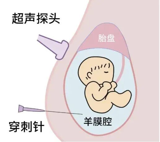 孕期必讀：產(chǎn)前篩查≠產(chǎn)前診斷，區(qū)別在這里！